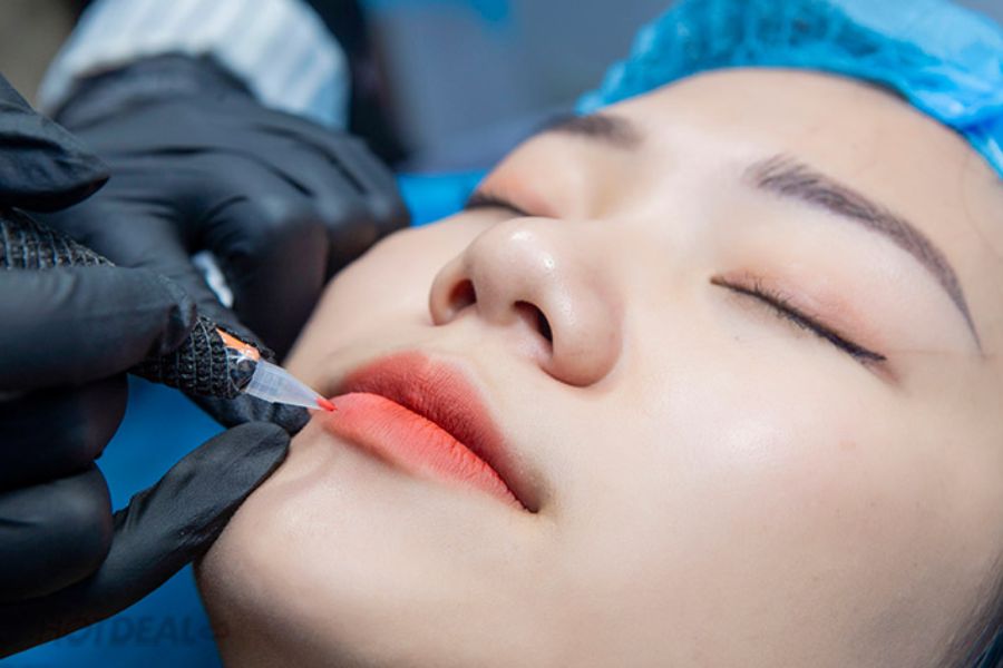 Laser trị môi thâm