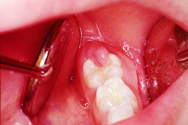 Viêm lợi trùm lên răng khôn