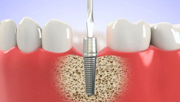 Cấy ghép Implant tuy là phương pháp phục hình răng hiệu quả nhưng không phải ai cũng là phương pháp phù hợp với mọi người