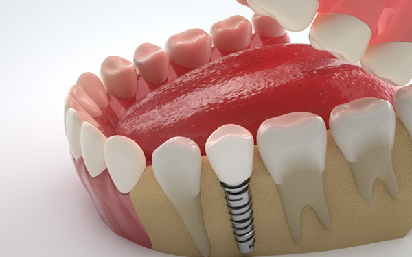 Trụ Implant đơn lẻ phù hợp với trường hợp chỉ mất 1 răng
