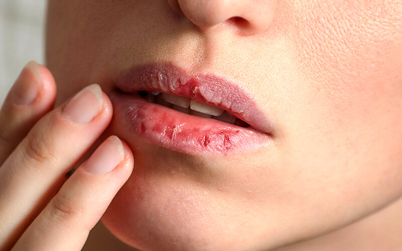 Môi trở nên khô hơn khi sử dụng son dưỡng quá nhiều Môi trở nên khô hơn khi sử dụng son dưỡng quá nhiều