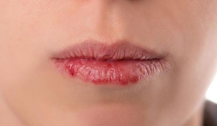 Gây kích ứng xung quanh môi khi sử dụng quá nhiều son dưỡng Gây kích ứng xung quanh môi khi sử dụng quá nhiều son dưỡng