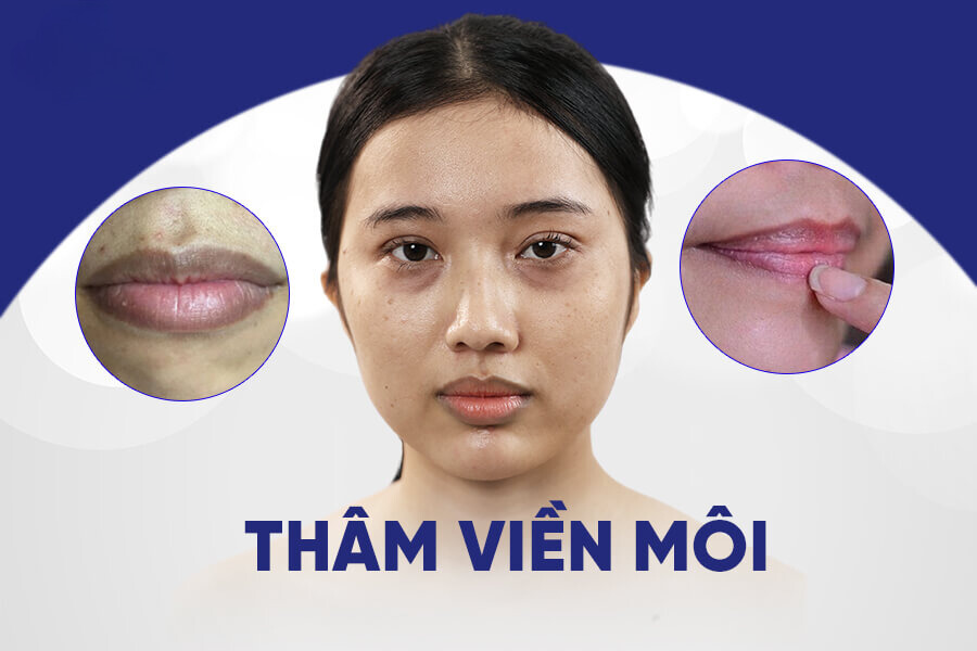 Thâm viền môi là gì?