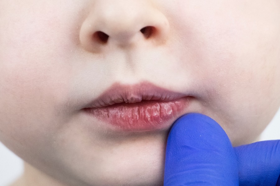 Tình trạng môi khô, nứt nẻ, thâm viền do không uống đủ nước