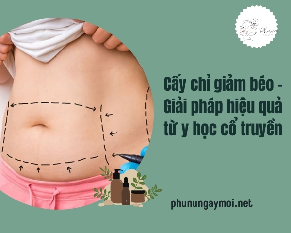 cấy chỉ giảm béo