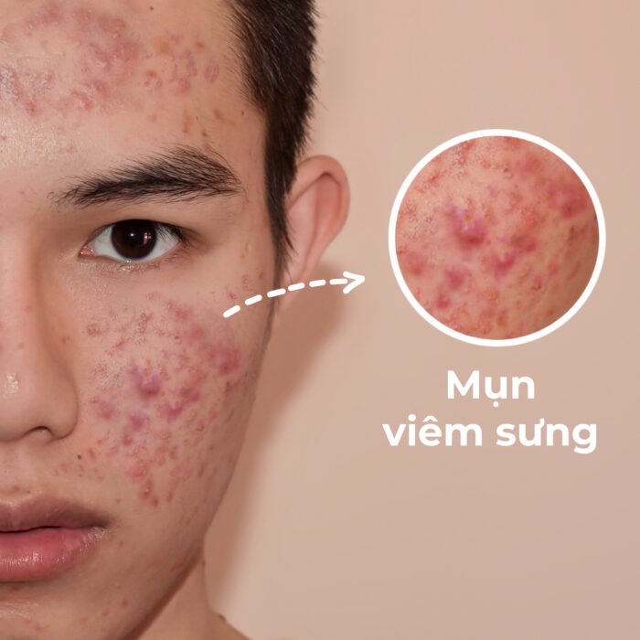 Tìm hiểu hiểu về mụn sưng