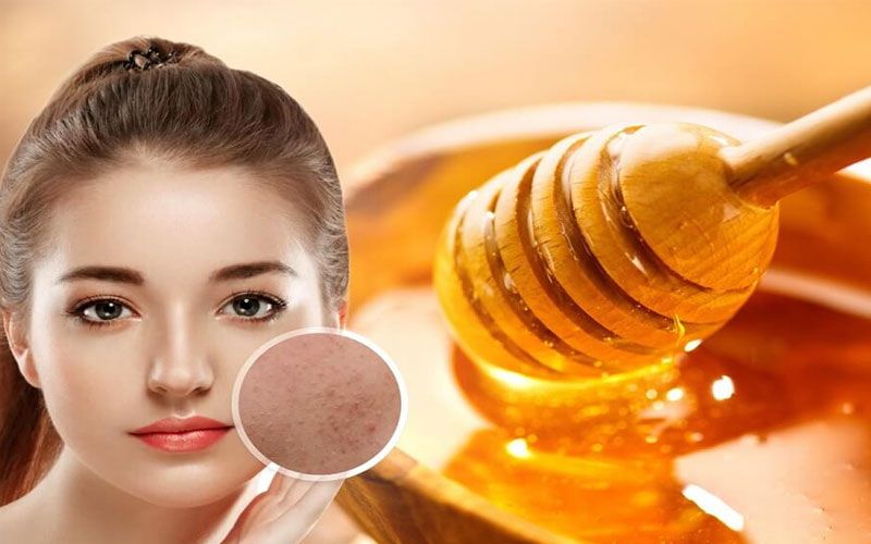 Cách giảm sưng mụn bằng mật ong nguyên chất