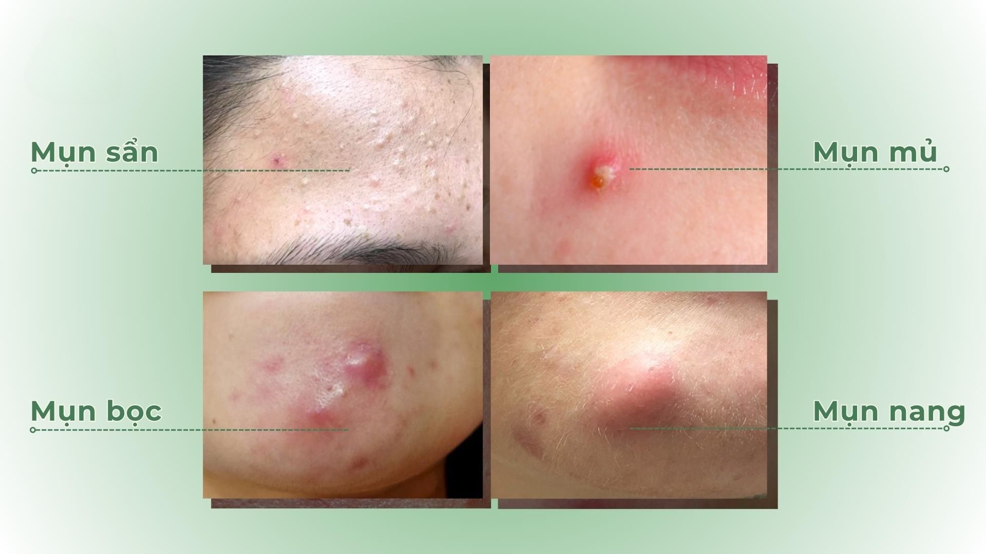 Các loại mụn sưng phổ biến