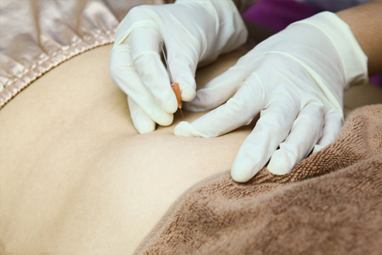 Khái niệm và nguồn gốc cấy chỉ giảm béo