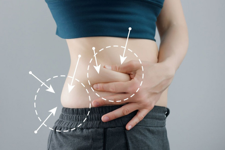 Đối tượng phù hợp cấy chỉ giảm béo