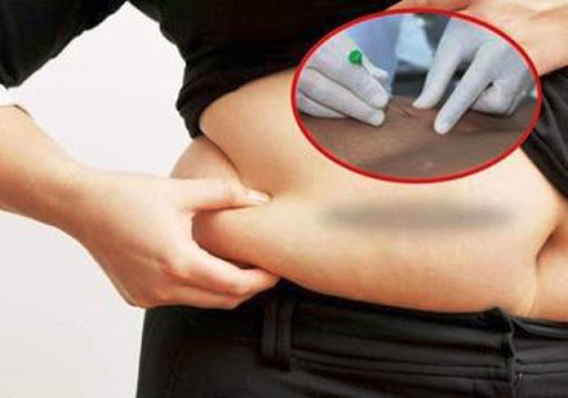 Lưu ý quan trọng về cấy chỉ giảm béo