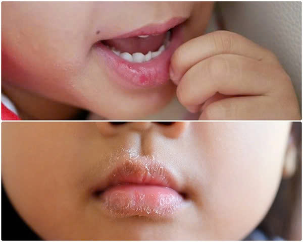 Nguyên nhân khiến môi trẻ bị khô nứt