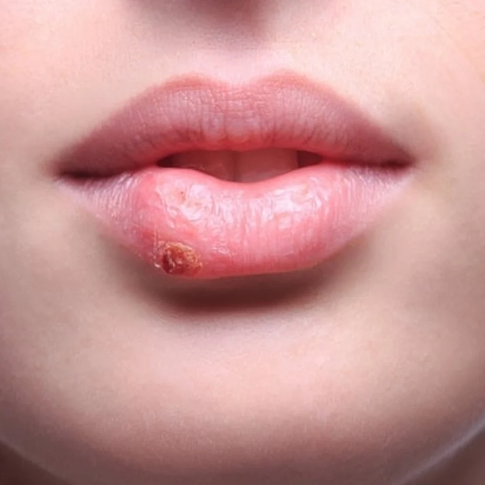 Phản ứng trên da Phản ứng trên da