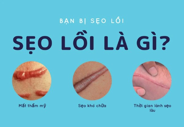 Sẹo lồi là gì? Đặc điểm của sẹo lồi