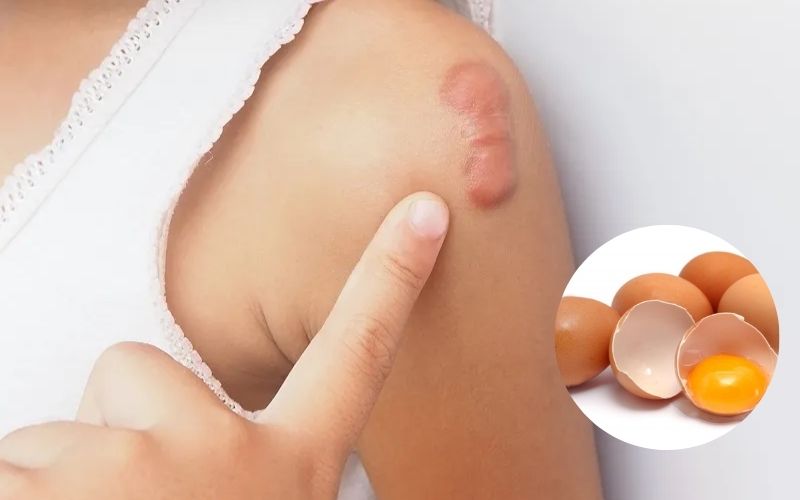 Ăn trứng có bị sẹo lồi không?