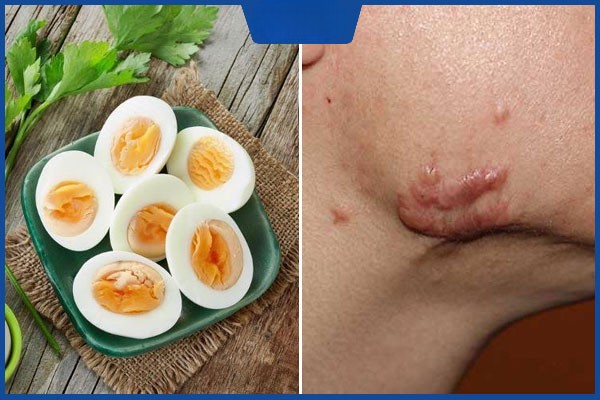 Bị sẹo lồi kiêng trứng bao lâu?