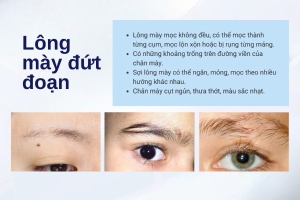 Thế nào là lông mày đứt đoạn?