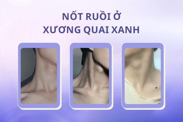 Nốt ruồi ở xương quai xanh – Số đào hoa, kết hôn muộn