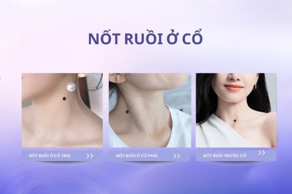 Nốt ruồi ở cổ – Mang đến điều không may