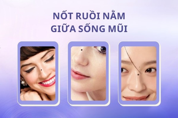Những vị trí nốt ruồi xấu trên mặt nên xóa ngay