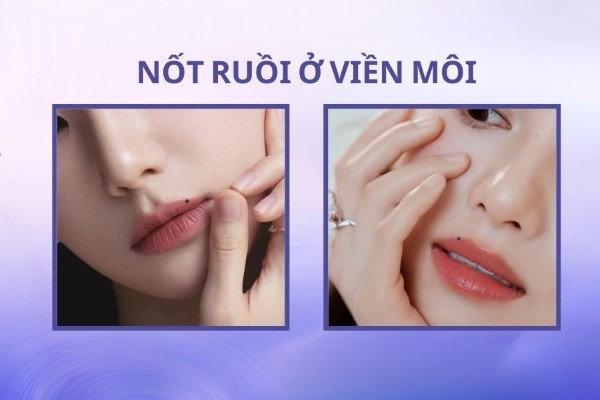 Nốt ruồi ở viền môi – Những nốt ruồi xui xẻo trên mặt