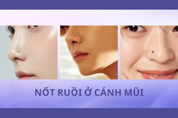 Những nốt ruồi xấu trên mặt – Nốt ruồi ở cánh mũi