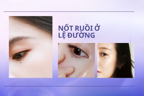 Nốt ruồi ở lệ đường – Nốt ruồi khổ sở vì tình