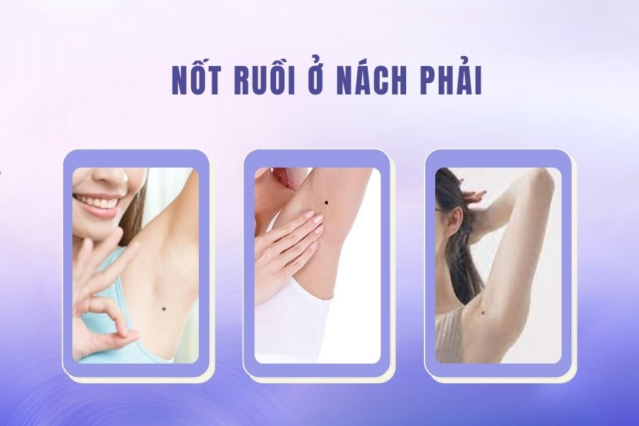 Nốt ruồi dưới nách phải của phụ nữ – Biểu tượng của tài vận phát đạt