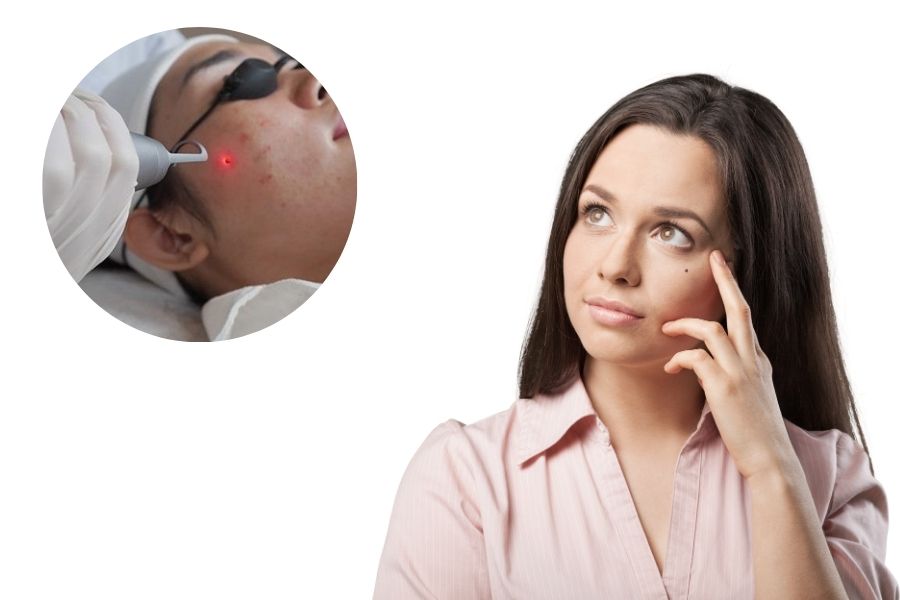 Nên tham khảo ý kiến chuyên gia trước khi quyết định tẩy/xóa nốt ruồi lệ