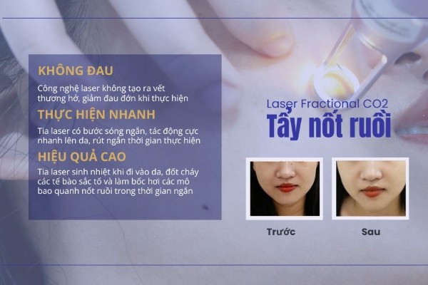 Hình ảnh khách hàng trước và sau khi tẩy/xóa nốt ruồi