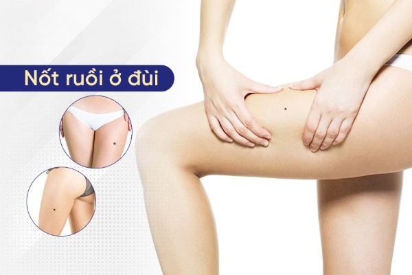 Nốt ruồi ở đùi trái mang đến cho người phụ nữ vận may gặt hái thành công