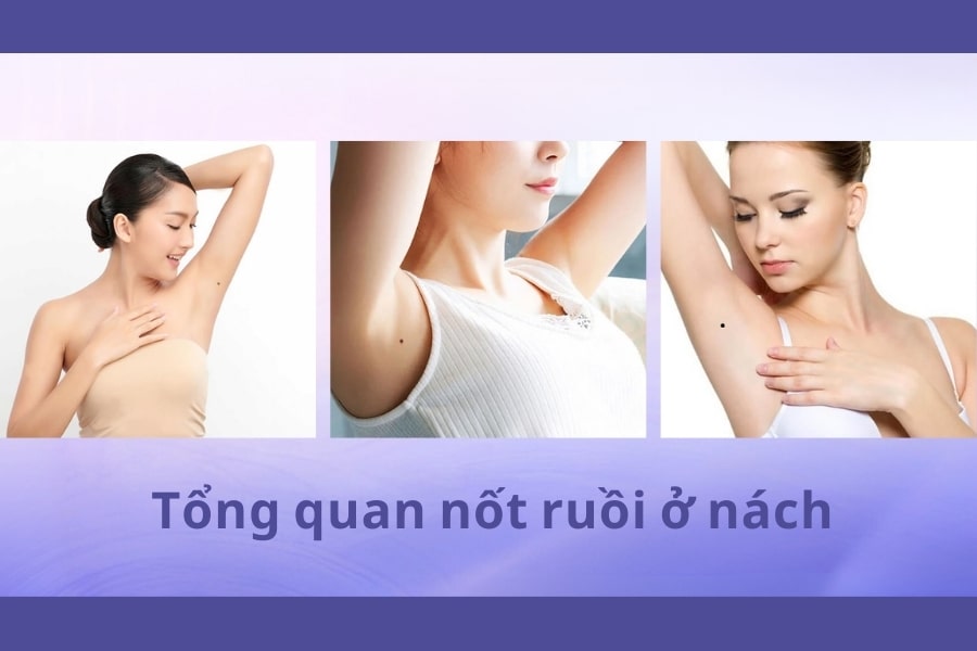 Tổng quan về nốt ruồi ở nách cho nam và nữ