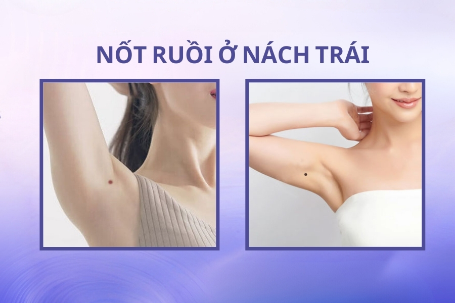 Nốt ruồi dưới nách trái của nữ – Gắn liền với sự giàu sang, phú quý