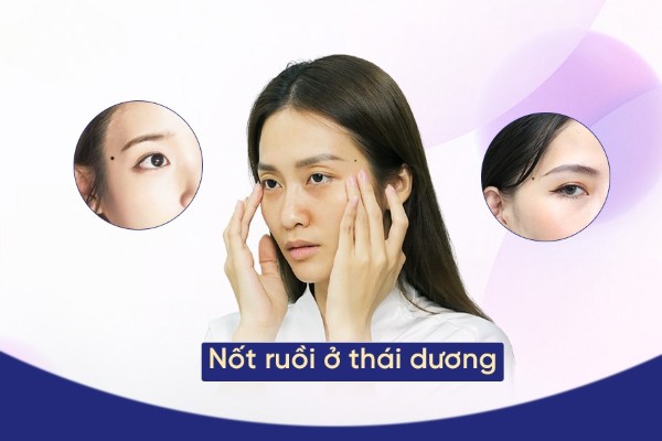 Ý nghĩa nốt ruồi ở thái dương: Dấu hiệu may mắn hay điềm xui?