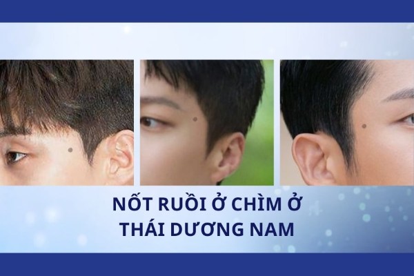 Nốt ruồi chìm ở thái dương nam - Nốt ruồi may mắn