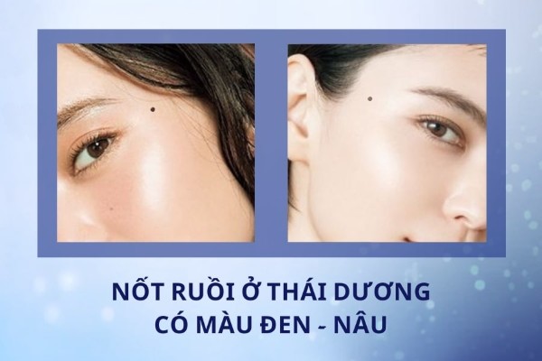 Nốt ruồi thái dương có màu đen hoặc nâu – Nữ may mắn hơn nam