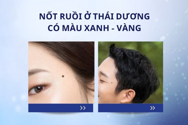 Nốt ruồi ở thái dương có màu xanh hoặc vàng – Nam nữ đều không được may