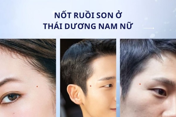 Nốt ruồi son thái dương – Nữ có tình cảm thuận lợi