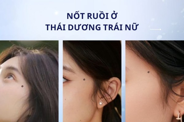 Nốt ruồi ở thái dương phải nữ có mang thông điệp giống bên trái không?