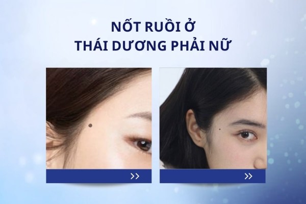 Nốt ruồi thái dương phải nữ là đặc điểm của người phụ nữ mạnh mẽ, độc lập