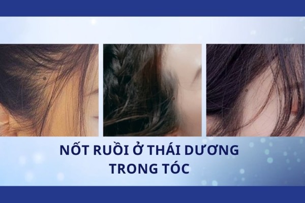 Nốt ruồi ở thái dương trong tóc ở phụ nữ – Vận mệnh tốt, sung sướng