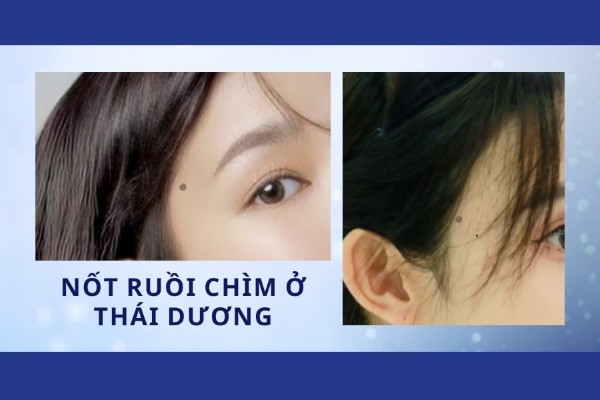 Nốt ruồi chìm ở thái dương nữ - Vận mệnh may mắn, có quý nhân phù trợ