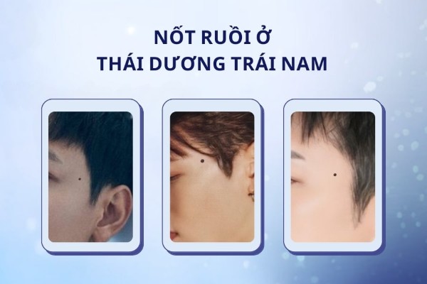 Nốt ruồi thái dương trái nam - Đàn ông bảo thủ và thẳng tính