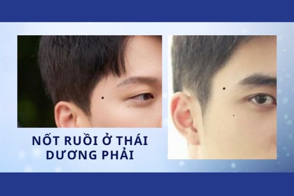 Nốt ruồi ở thái dương phải nam - Sức khỏe kém, không có chí tiến thủ