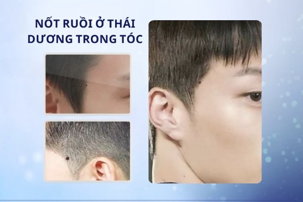 Nốt ruồi ở thái dương trong tóc ở nam - Đại hạn tiền bạc và sức khỏe