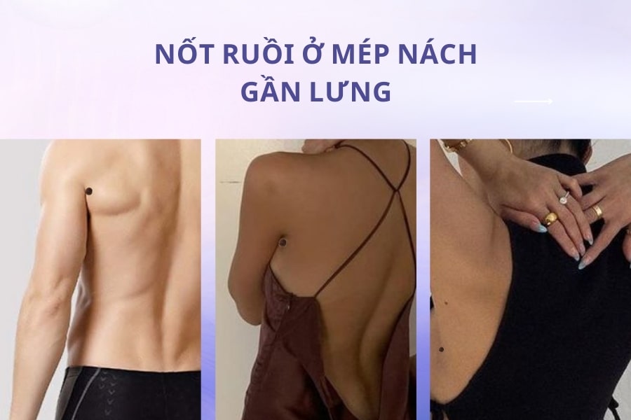 Nốt ruồi ở mép nách sát lưng – Nốt ruồi quý không nên xóa bỏ