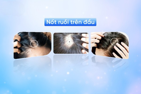 Nốt ruồi trên đầu mang những ý nghĩa gì? Cùng chuyên gia tìm hiểu ngay Nốt ruồi trên đầu mang những ý nghĩa gì? Cùng chuyên gia tìm hiểu ngay
