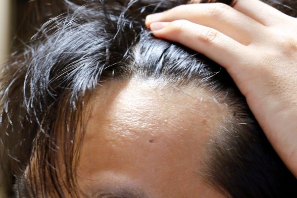 Đàn ông có nốt ruồi ở đầu thường được xem là trụ cột chính của gia đình, là chỗ dựa vững chắc cho vợ và con Đàn ông có nốt ruồi ở đầu thường được xem là trụ cột chính của gia đình, là chỗ dựa vững chắc cho vợ và con