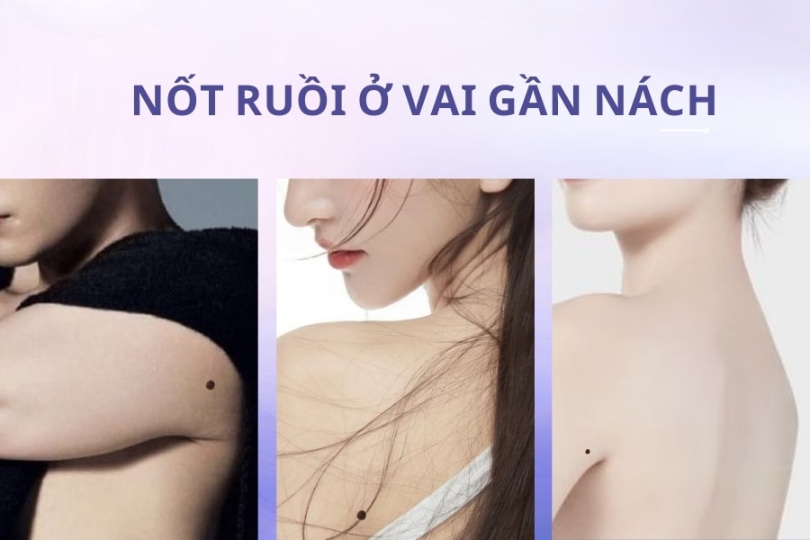 Nốt ruồi ở vai gần nách – Cuộc đời luôn gặp nhiều may mắn