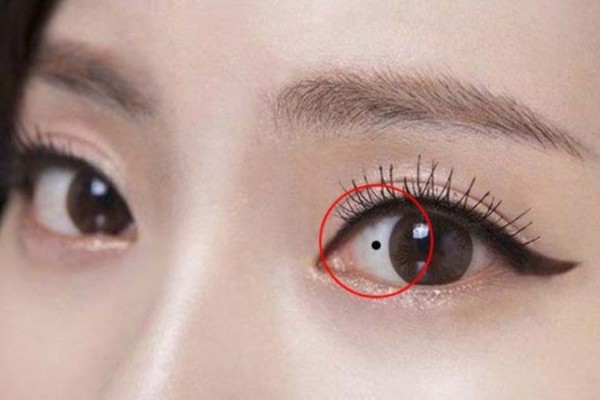 Nốt ruồi trong lòng trắng mắt – Khó bề yên ổn